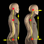 Rundrücken, Hohlkreuz, Flachrücken, Skoliose: Was&nbsp;tun?!
